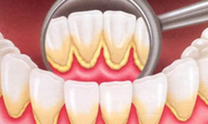 Doença Periodontal